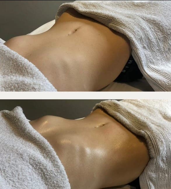 Photos avant et après une cure de drainage lymphatique : ventre et taille affinés
